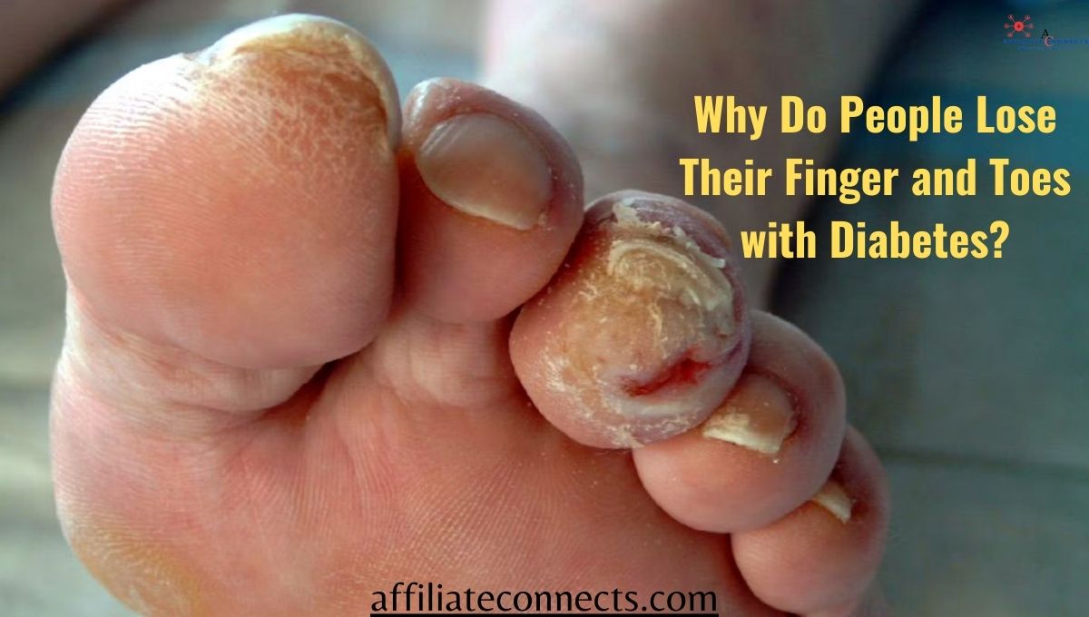 Why Do People Lose Their Finger and Toes with Diabetes