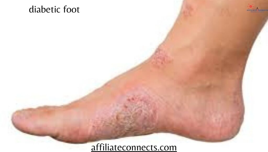 Why Do People Lose Their Finger and Toes with Diabetes