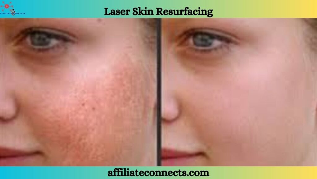 Laser skin resurfacing